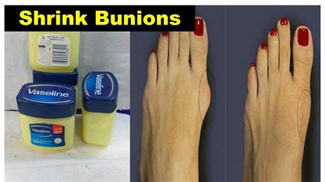 The joint in our big toe is important to keep our balance and is used to carry a lot of our body. How to get rid of bunions on pinky toe without surgery ...