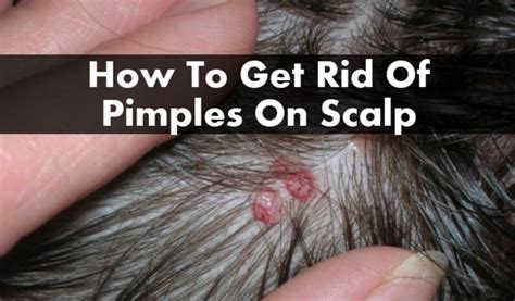 10 Home Remedies To Get Rid Of Pimples On Scalpscalp Acne