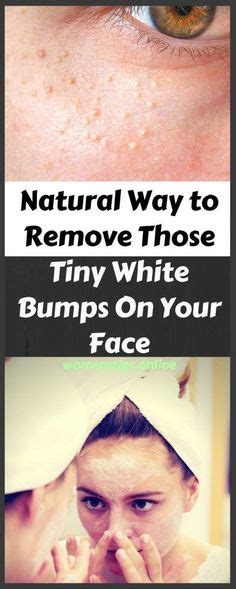 How To Get Rid Of Milia White Pimples On Face Skin Bumps On Face