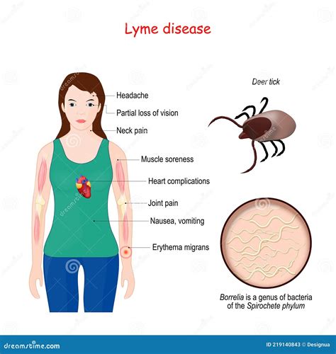 Lyme Disease. Woman With Erythema, Signs And Symptoms Lyme Borreliosis