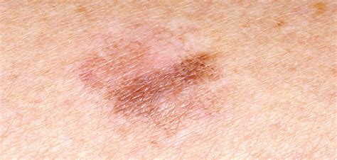 Immunotherapy Of Precancerous Skin Lesions May Prevent Squamous Cell