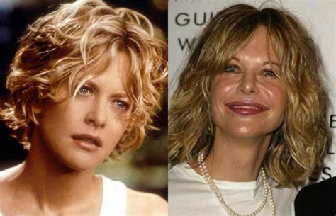 Viso E Decolletè Più Tonici Con La Biostimolazione E Non Come Lattrice Meg Ryan Diventata