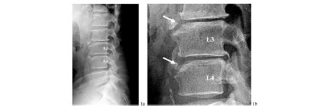 Anterior Limbus Vertebra Affecting L3 And L4 Lateral Radiography Of