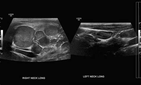 Ultrasound Image Shows Bilateral Cervical Lymphadenopathy Right More
