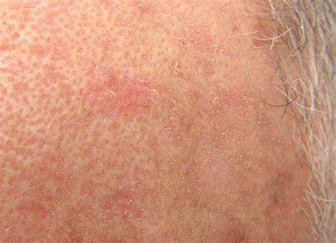 Actinic Keratoses Are Precancerous Lesions Common On Sun Exposed Areas Of The Skin They Can
