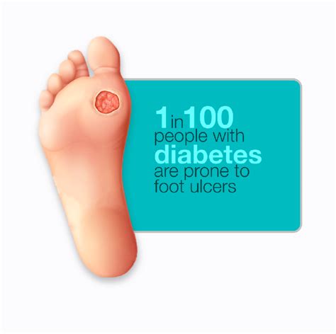 Diabetic Foot Ulcers Risk Factors Symptoms Treatment