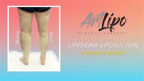 Lipedema Leg Liposuction Surgery Cankles And Knees Immediate Results
