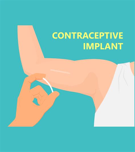 birth control implant benefits and side effects