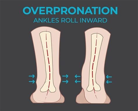 Difference Between Pronation And Overpronation