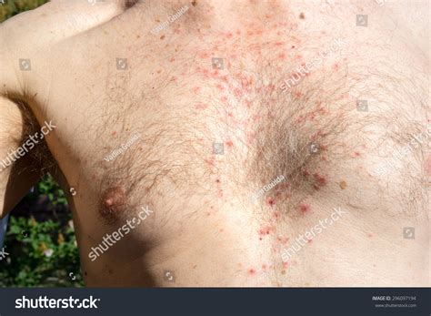 Photo De Stock Chest Skin Rash Drug Side Effect 296097194 Shutterstock