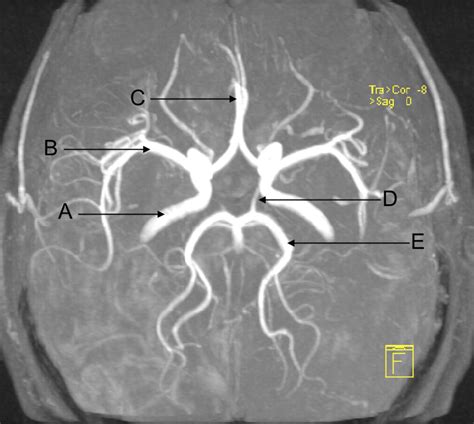 Magnetic Resonance Angiogram Of The Brain The Bmj