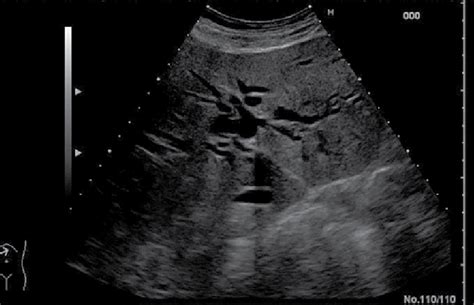 Dilated Intrahepatic Ducts Ultrasound