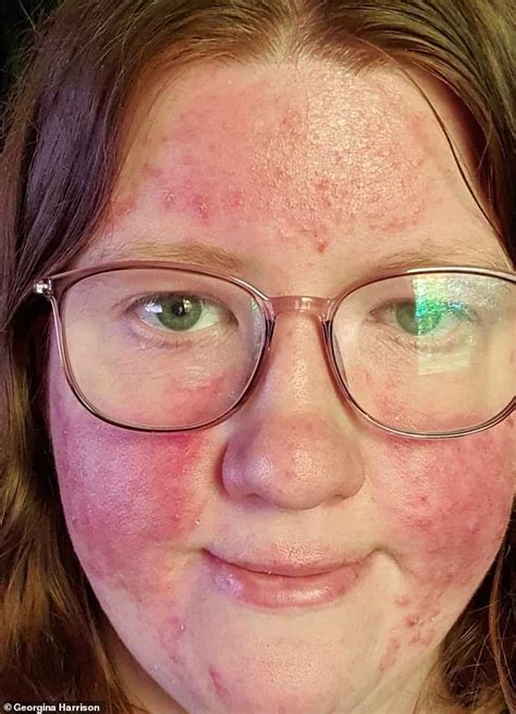 Rosacea Sufferer Claims £19 Concealer Made With Capers Improved Skin