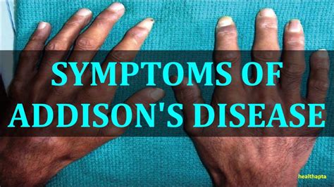Symptoms Of Addison S Disease Addisons Disease Addison’s Disease Cushings Syndrome