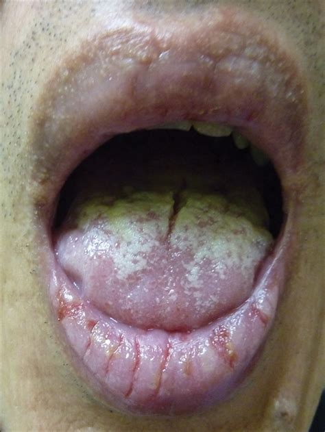 Sore Upper Lip Inside Mouth