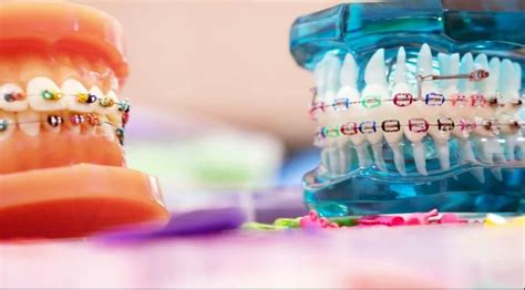 Why Purple Braces Are The Latest Trend In Orthodontics