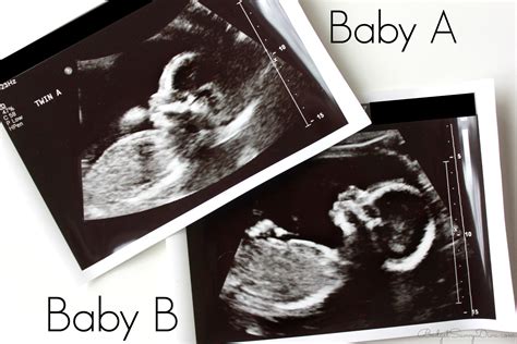 20 Weeks Ultrasound Update Twins Budget Savvy Diva
