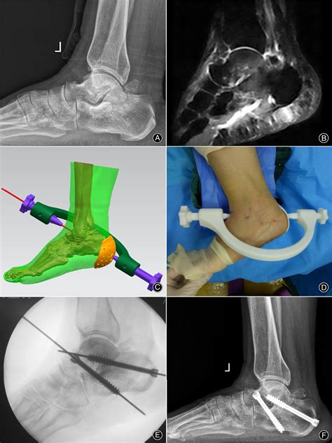 Application Of 3d‐printed Customized Guides In Subtalar Joint
