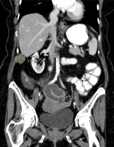 Ct Scan Of The Abdomen And Pelvis With Contrast Showing Right