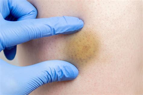 How To Diagnose And Treat A Hard Lump Under Skin After A Bad Bruise