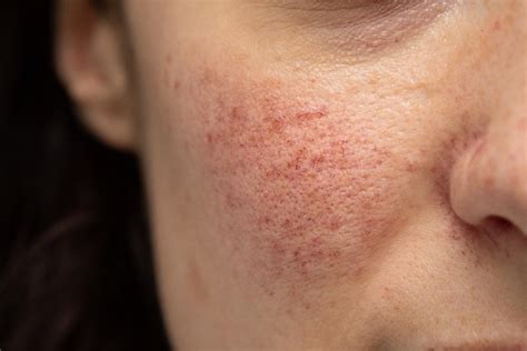 Rosacea Routine Beauty And Health