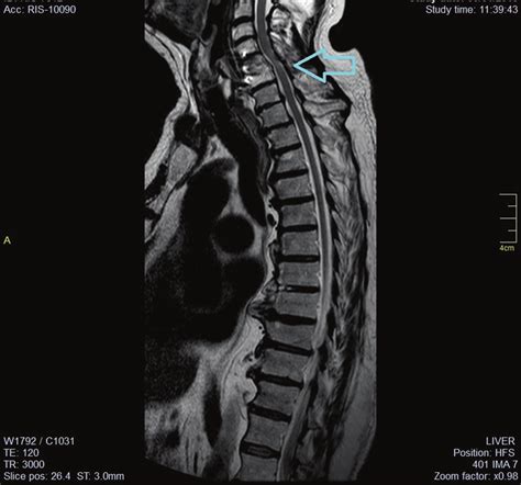 Sagittal Magnetic Resonance Imaging Image Of The Cervical Spine Showing