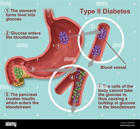 Type 2 Diabetes Stock Photo Alamy