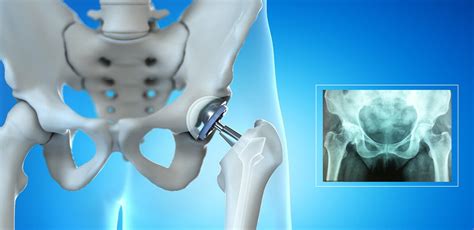 Hip Arthroplasty Best Joint Replacement Surgeon