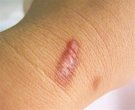 Best Burn Mark Stock Photos Pictures And Royalty Free Images Istock