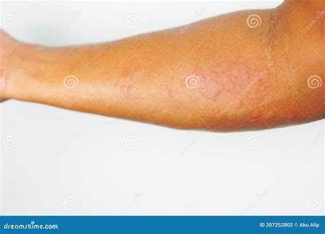 Close Up Allergy Rash On Sensitive Skin Stock Photo Image Of