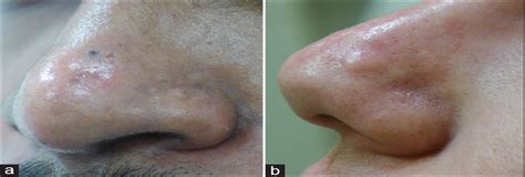 Papular Acne Scars Of The Nose And Chin An Under Recognised Journal Of Cutaneous And