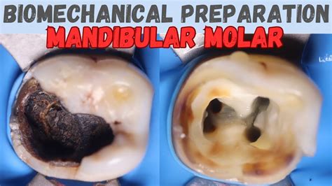 Biomechanical Preparation In Mandibular Molar Mandibular First Molar