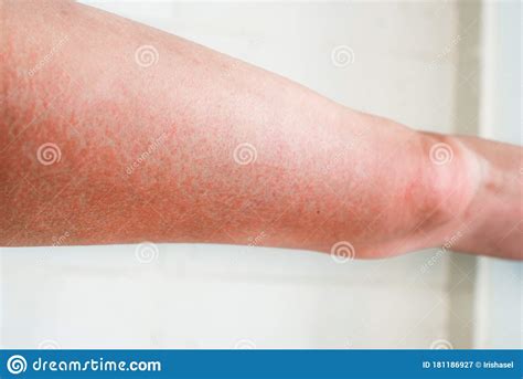 Blisters On A Legs After Ant Bite Solenopsis Geminata Tropical Fire Ant Royalty Free Stock