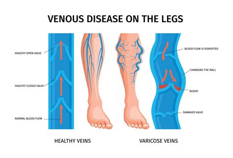 Venous Disease Of Legs Infographics Poster 10317111 Vector Art At Vecteezy