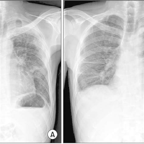 Chest Radiographs Post Steroid Therapy At 3 Days A And 1 Year B