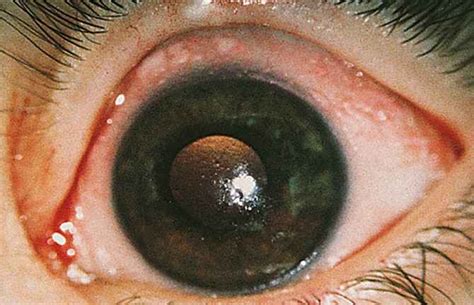 Eye Diseases Name In Gujarati Astigmatism Glaucoma Swollen Eyes Disease