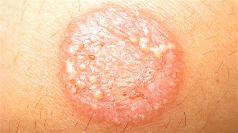 Tinea Corporis Body Ringworm Treatment And More