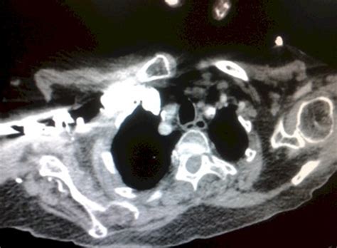 El valor de la tac de tórax helicoidal para el diagnóstico de tromboembolismo pulmonar depende si puede excluirse trombosis venosa profunda por arm de pelvis y mi, la presencia de embolias. Disnea subita tras artroplastia de cadera - Revista ...
