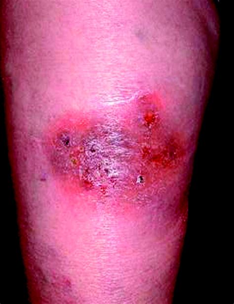 Diagnosis And Treatment Of Pyoderma Gangrenosum The Bmj