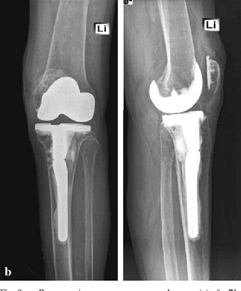 Figure 1 From Early Primary Total Knee Replacement For Complex Proximal