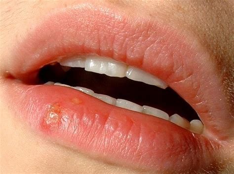 Blister On Lip Causes Treatment And Prevention