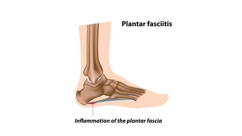 The Plantar Fasciitis Treatment Program At Cathedral Osteopaths