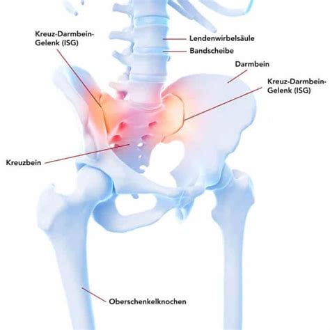 Gymnastische übungen aus der physiotherapie, etwa in form von yoga, helfen von spondylitis. ISG-Schmerzen -- Das ist die wahre Ursache der ...