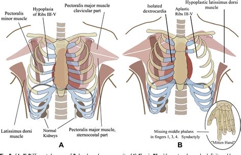 Figure 8 From Thoracic Defects Cleft Sternum And Poland Syndrome