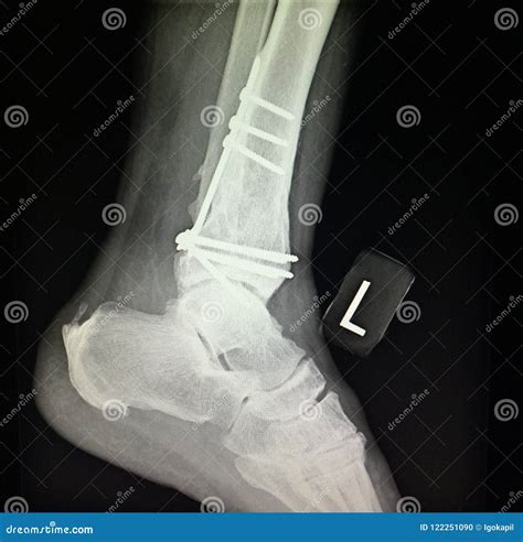 Ankle Left Tibia Distal Fracture Treatment Xray Stock Photo Image Of