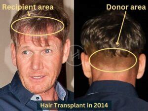 Gordon Ramsay Hair Transplant Hair Loss Technical Analysis