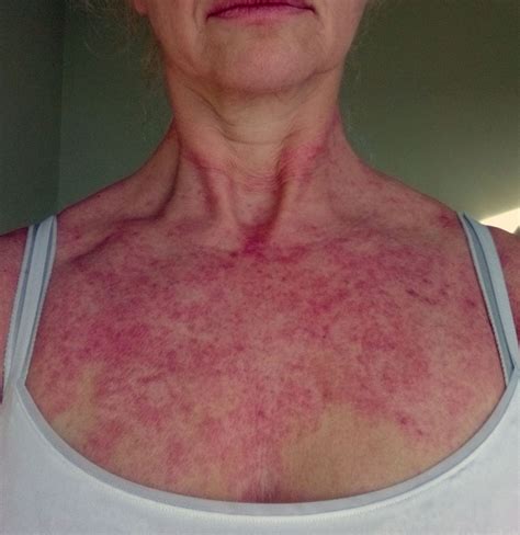 Discovering Menopause Itchy Skin The Coddiwomple Lady