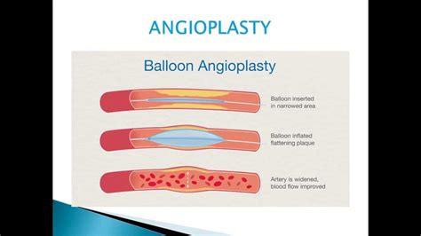 Angiogram And Angioplasty Youtube