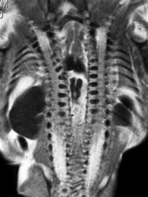 Conjoined Twins Postmortem Mri Showing The Spinal Fusion Download