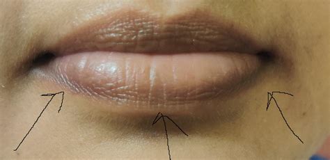 Skin Concerns Ive Had Cracked Lips And A Dark Outline Under My Lips